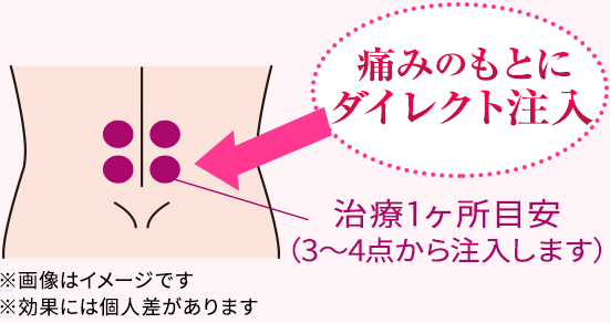 痛みのもとにダイレクト注入