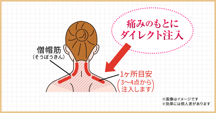 痛みのもとにダイレクト注入