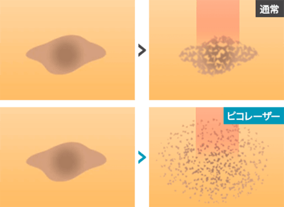 従来のレーザーに比べ、ピコレーザーはメラニン色素の粒子をより細かく破壊【画像】