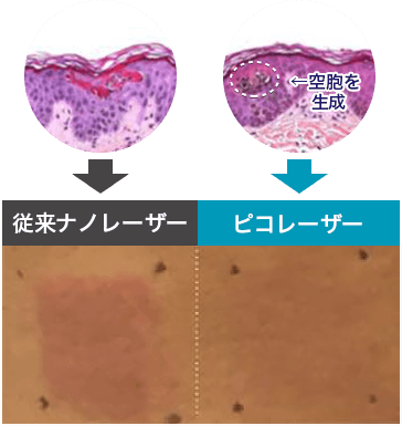 レーザー照射後の色素沈着のリスクが少ない【画像】