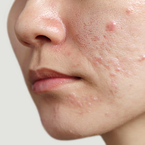 京都院のニキビ跡治療