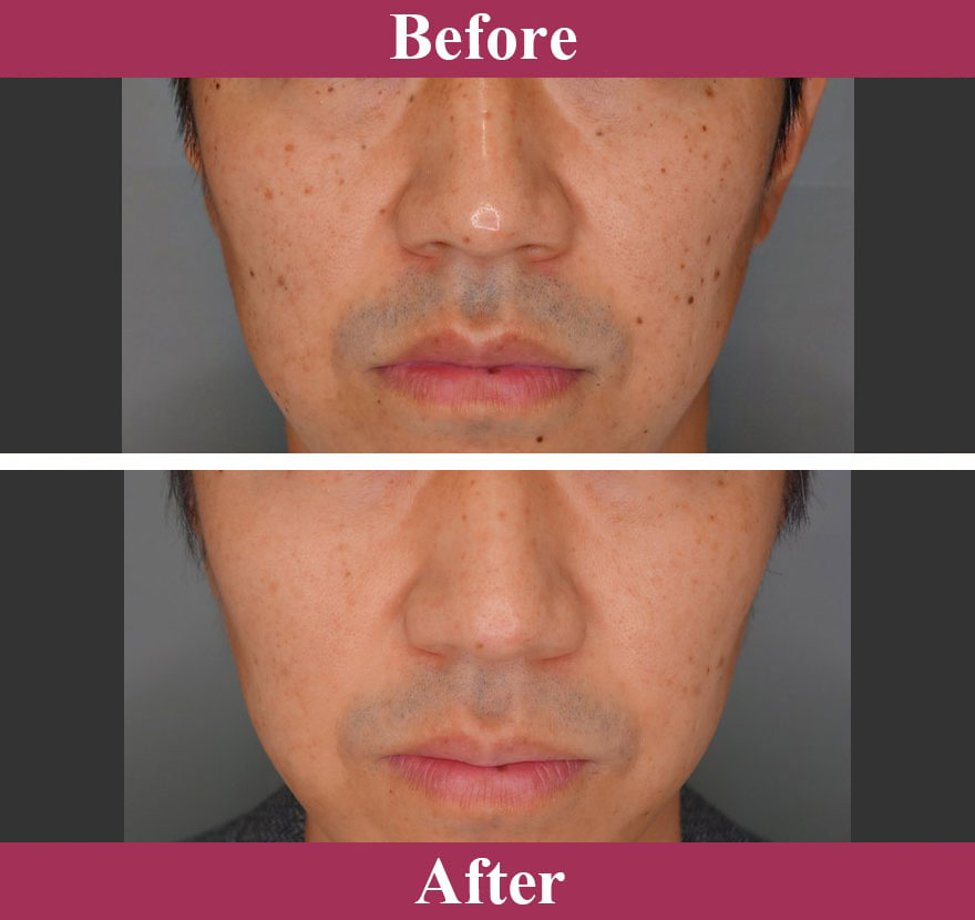 Qスイッチヤグレーザー 症例写真【画像】