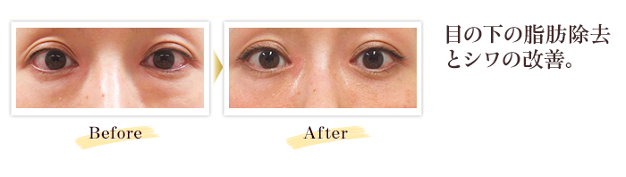 目の下の脂肪除去とシワの改善。