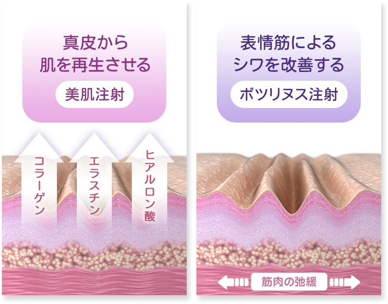 真皮から肌を再生させる[美肌注射]+表情筋によるシワを改善する[ボツリヌス注射]