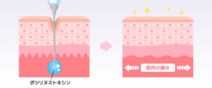 即効性のあるシワ取り