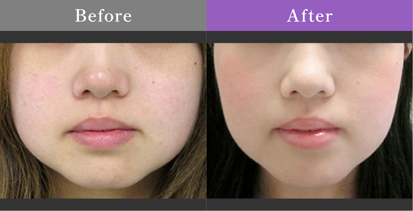 症例写真 Before After 01