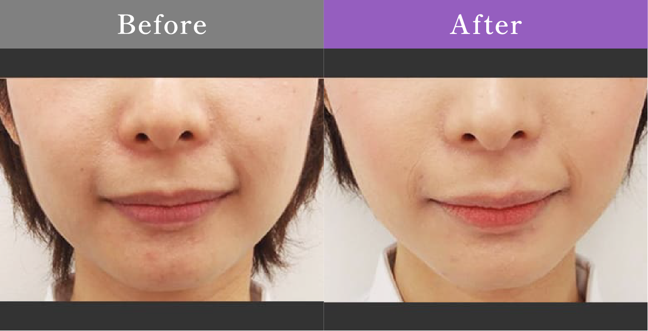 症例写真 Before After 02