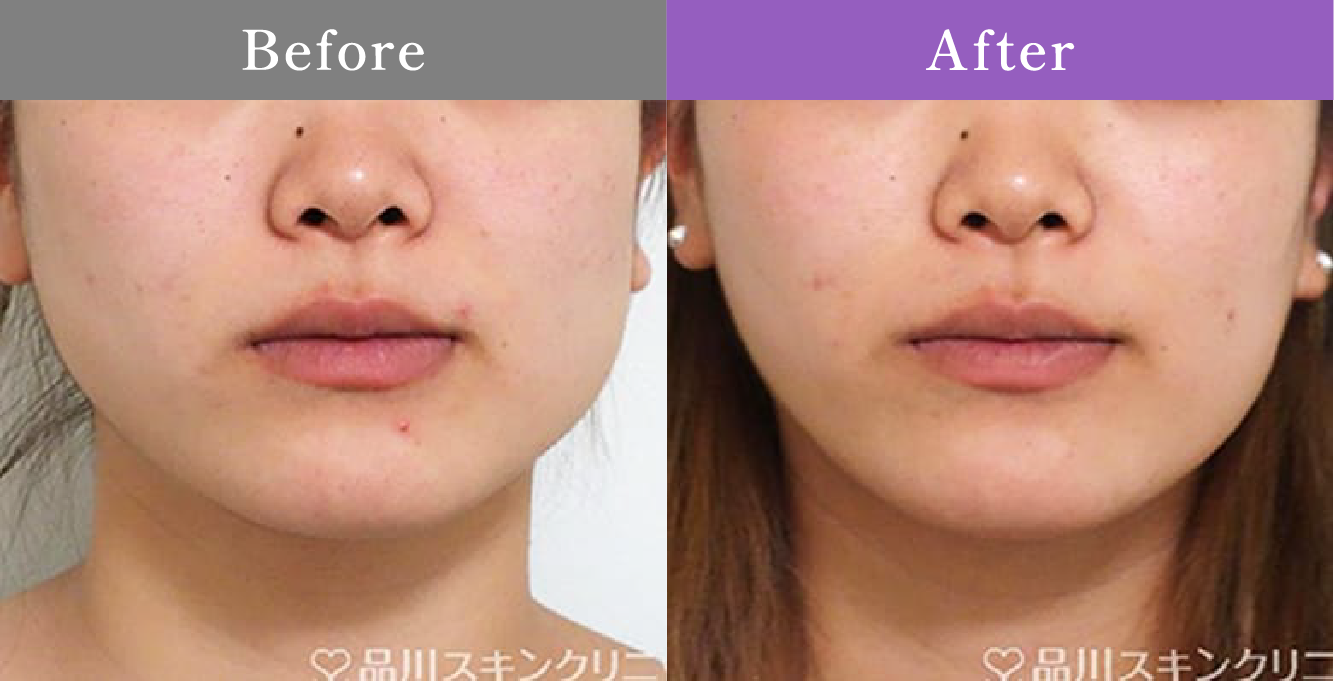 症例写真 Before After 01