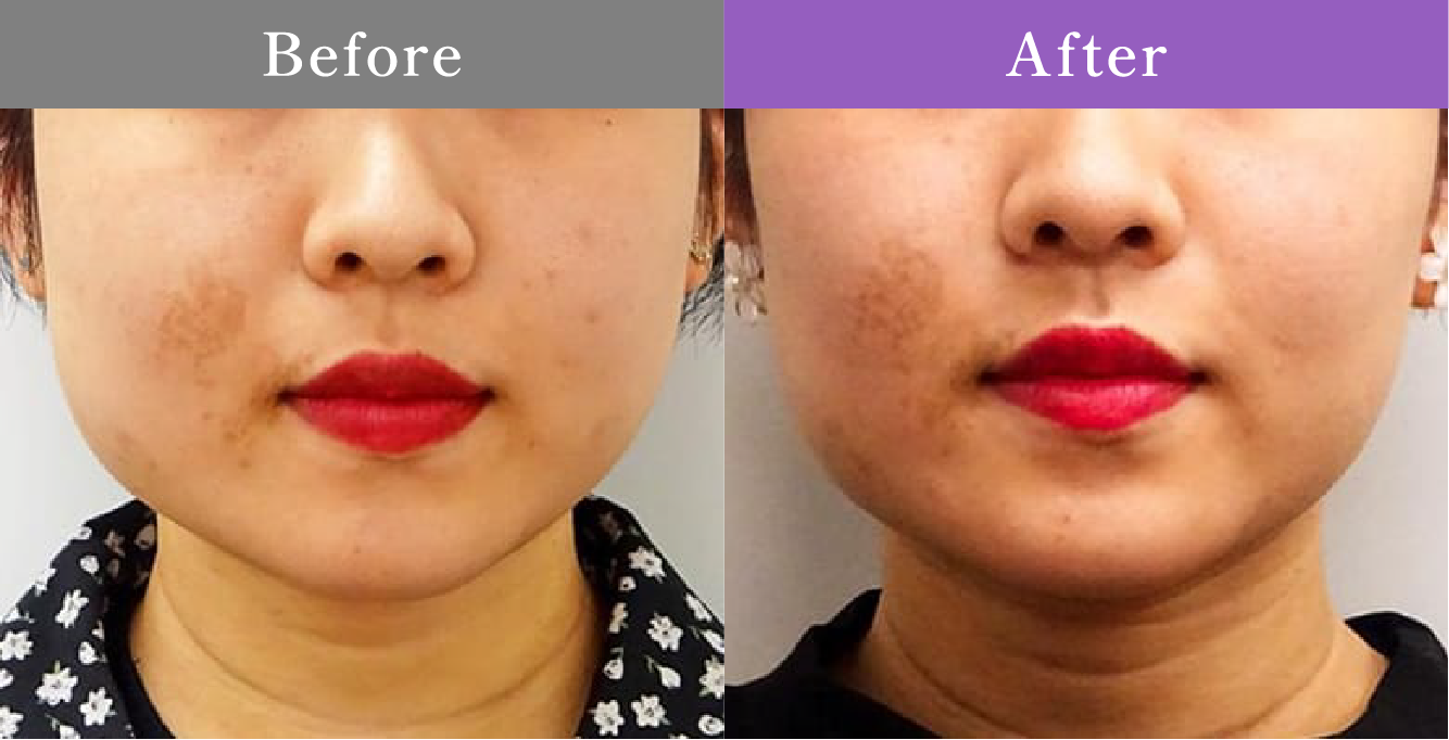 症例写真 Before After 01