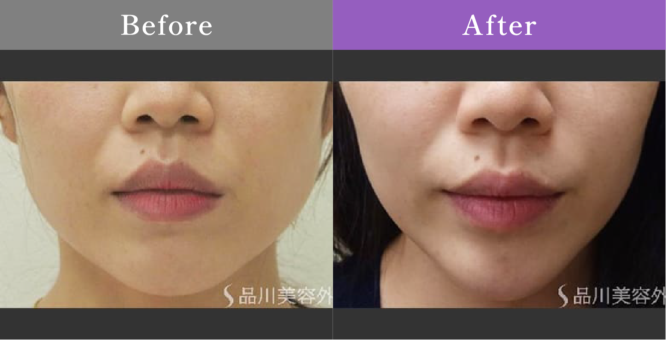 症例写真 Before After 01