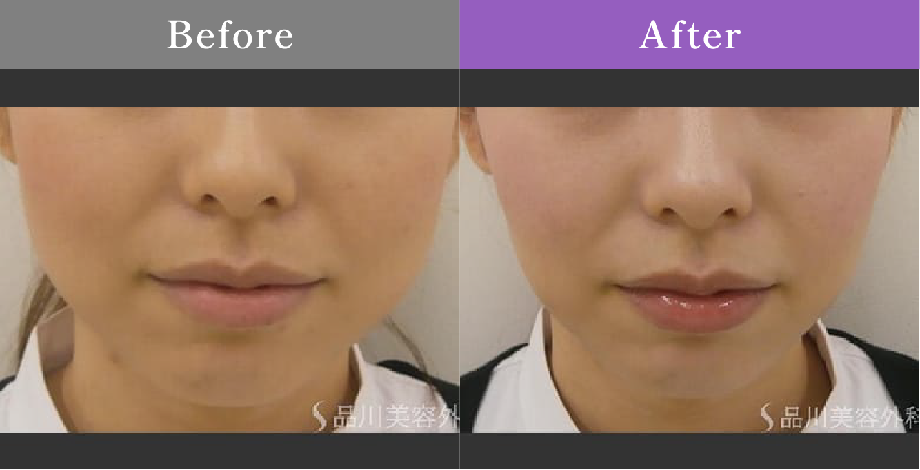症例写真 Before After 01