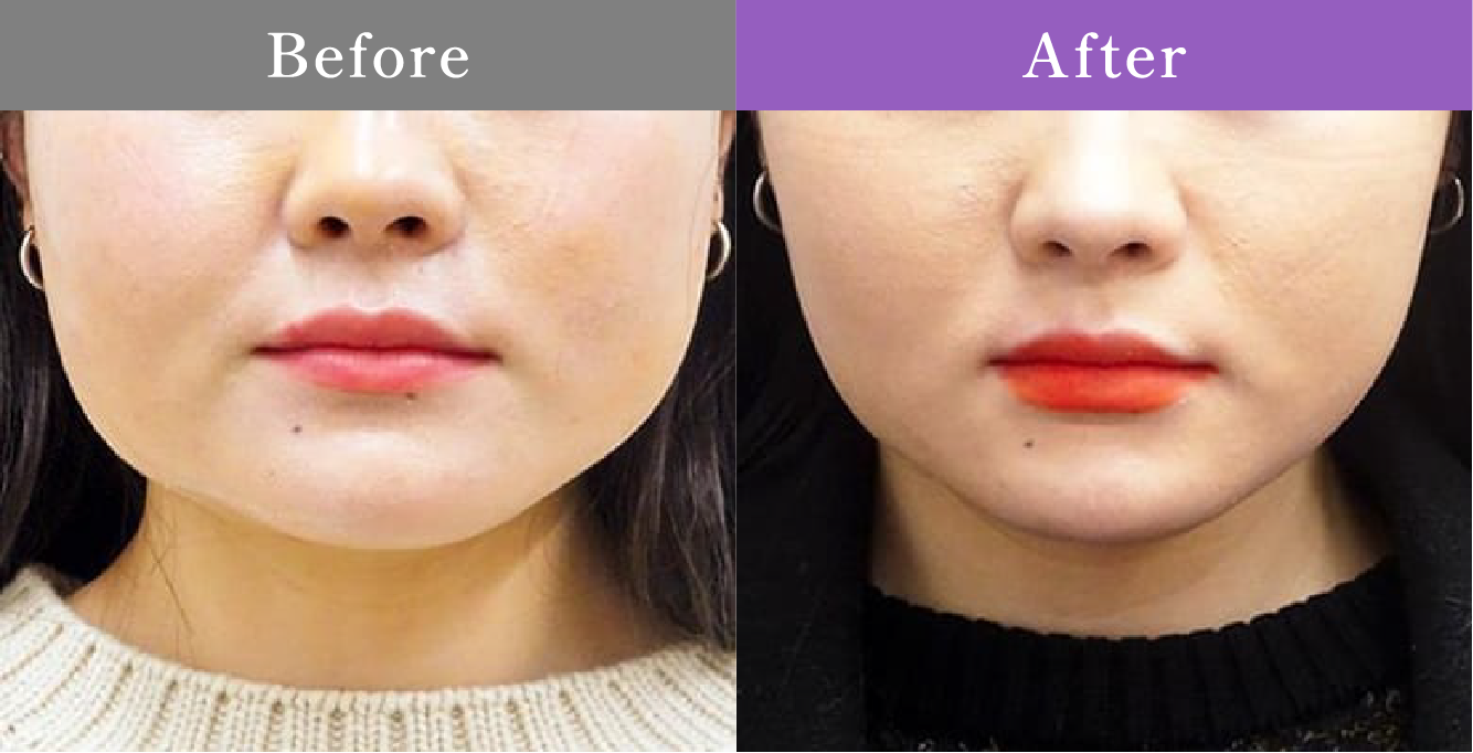 症例写真 Before After 07