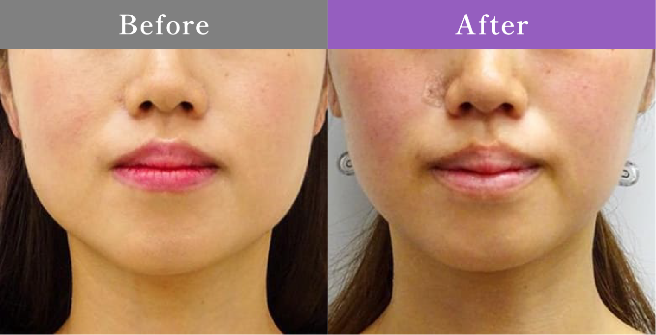 症例写真 Before After 08