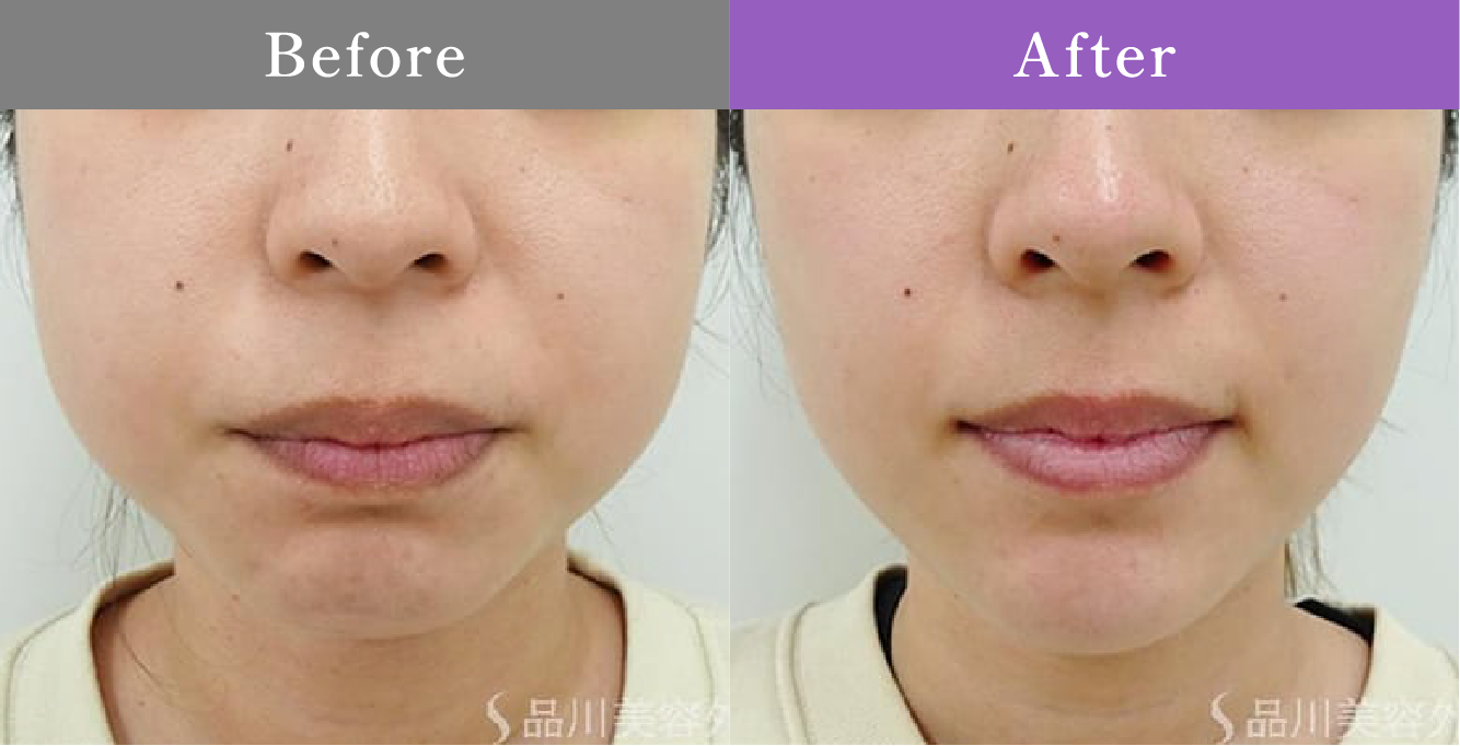 症例写真 Before After 09