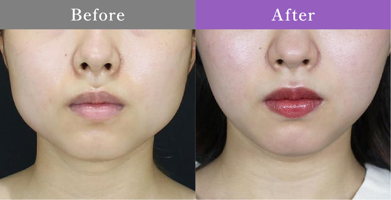 症例写真 Before After 10