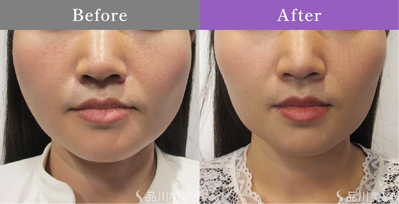 症例写真 Before After 11