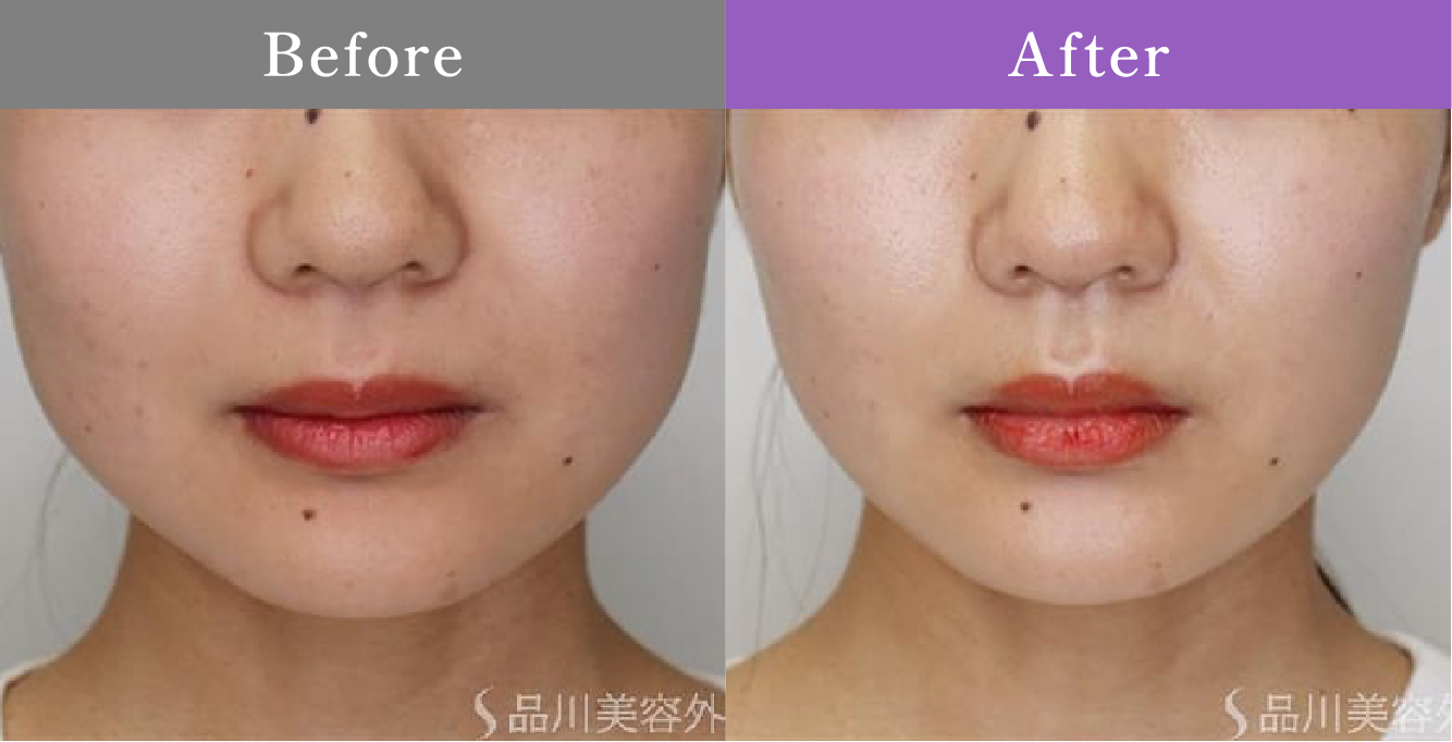 症例写真 Before After 12