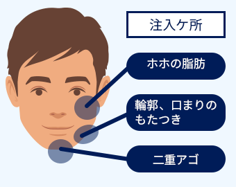 1日脂肪取り顔やせ