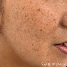 フォトシルクプラス BEFORE