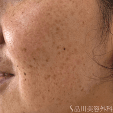 フォトシルクプラス BEFORE