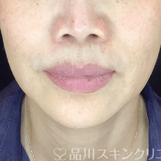 フォトシルクプラス AFTER