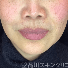 フォトシルクプラス BEFORE