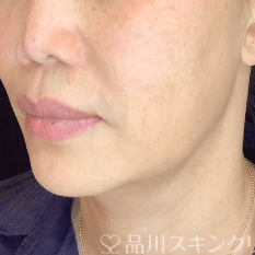 フォトシルクプラス AFTER