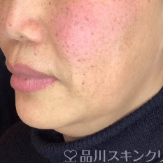 フォトシルクプラス BEFORE