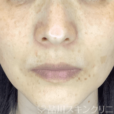 フォトシルクプラス AFTER