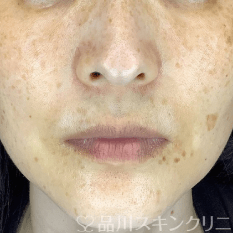 フォトシルクプラス BEFORE