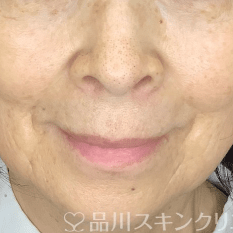 フォトシルクプラス AFTER