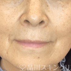 フォトシルクプラス BEFORE
