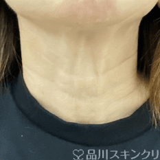 美肌注射 AFTER