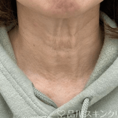 美肌注射 BEFORE