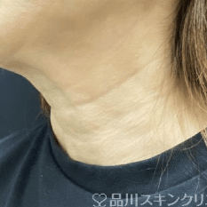 美肌注射 AFTER