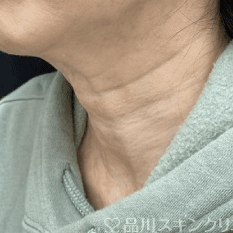 美肌注射 BEFORE