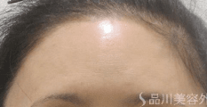 美肌注射 AFTER
