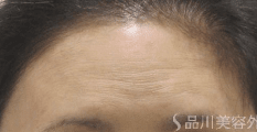 美肌注射 BEFORE