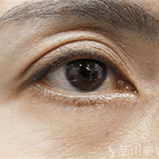 美肌注射 AFTER