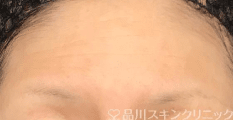 ヒアルロン酸注入 AFTER