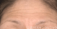 ヒアルロン酸注入 BEFORE