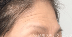 ヒアルロン酸注入 BEFORE