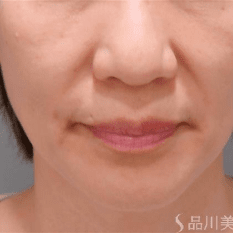 医療ハイフ（HIFU）第3世代タイタン BEFORE