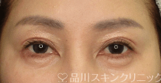 まぶたリフト（切らないまぶたのたるみ取り） AFTER