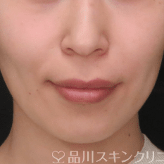 糸リフト（美肌糸リフト） BEFORE