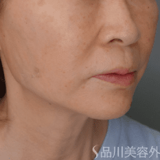 糸リフト（美肌糸リフト） AFTER