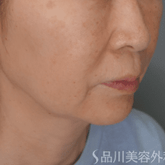 糸リフト（美肌糸リフト） BEFORE