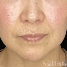 糸リフト（美肌糸リフト） BEFORE