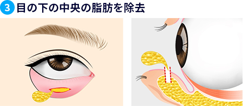 目の下の中央の脂肪を除去