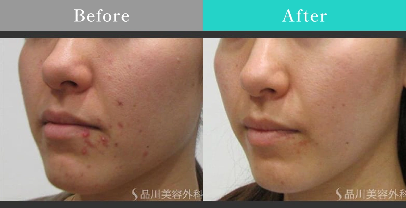 症例写真 Before After 01